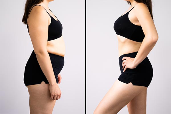 Liposuction Procedure - Before and After Treatment at Kureshi Med Spa in McKinney, TX Liposuction Procedure - Before and After Treatment at Kureshi Med Spa in McKinney, TX