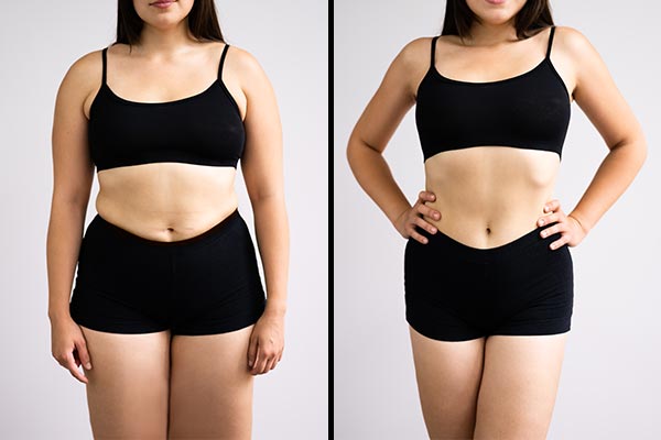 Liposuction Procedure - Before and After Treatment at Kureshi Med Spa in McKinney, TX Liposuction Procedure - Before and After Treatment at Kureshi Med Spa in McKinney, TX