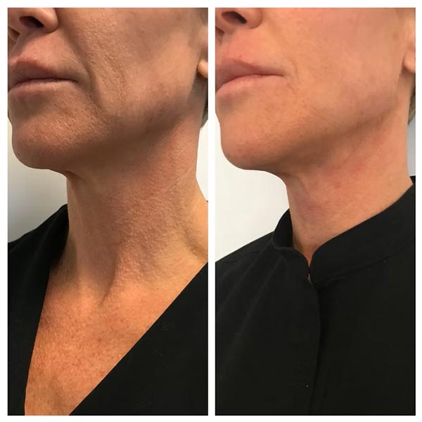 Other Treatments - Before and After Treatment at Kureshi Med Spa and Weight Loss in McKinney, TX Other Treatments - Before and After Treatment at Kureshi Med Spa and Weight Loss in McKinney, TX