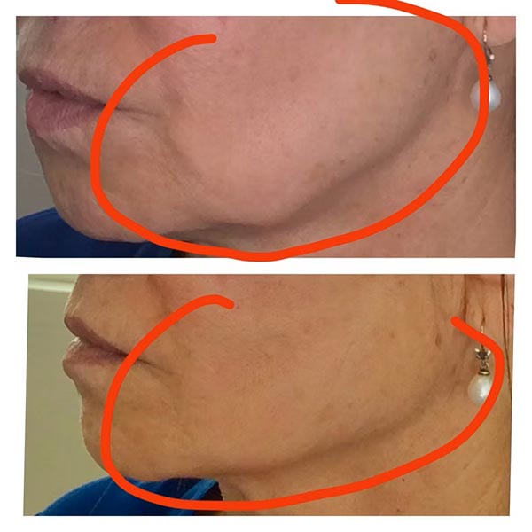 Other Treatments - Before and After Treatment at Kureshi Med Spa and Weight Loss in McKinney, TX Other Treatments - Before and After Treatment at Kureshi Med Spa and Weight Loss in McKinney, TX