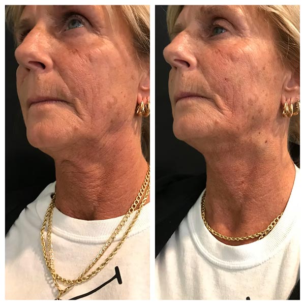 Other Treatments - Before and After Treatment at Kureshi Med Spa and Weight Loss in McKinney, TX Other Treatments - Before and After Treatment at Kureshi Med Spa and Weight Loss in McKinney, TX