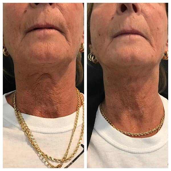 Other Treatments - Before and After Treatment at Kureshi Med Spa and Weight Loss in McKinney, TX Other Treatments - Before and After Treatment at Kureshi Med Spa and Weight Loss in McKinney, TX