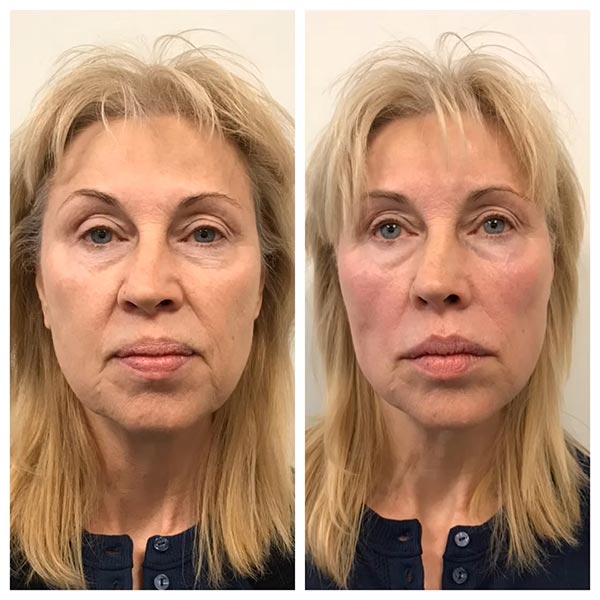 Other Treatments - Before and After Treatment at Kureshi Med Spa and Weight Loss in McKinney, TX Other Treatments - Before and After Treatment at Kureshi Med Spa and Weight Loss in McKinney, TX