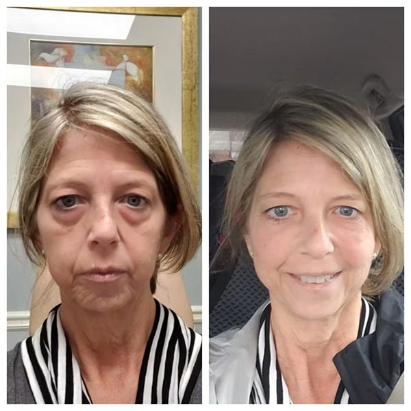 Other Treatments - Before and After Treatment at Kureshi Med Spa and Weight Loss in McKinney, TX Other Treatments - Before and After Treatment at Kureshi Med Spa and Weight Loss in McKinney, TX