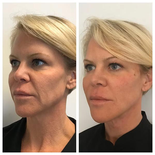 Other Treatments - Before and After Treatment at Kureshi Med Spa and Weight Loss in McKinney, TX Other Treatments - Before and After Treatment at Kureshi Med Spa and Weight Loss in McKinney, TX