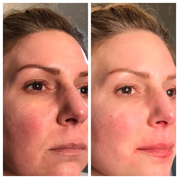 Other Treatments - Before and After Treatment at Kureshi Med Spa and Weight Loss in McKinney, TX Other Treatments - Before and After Treatment at Kureshi Med Spa and Weight Loss in McKinney, TX