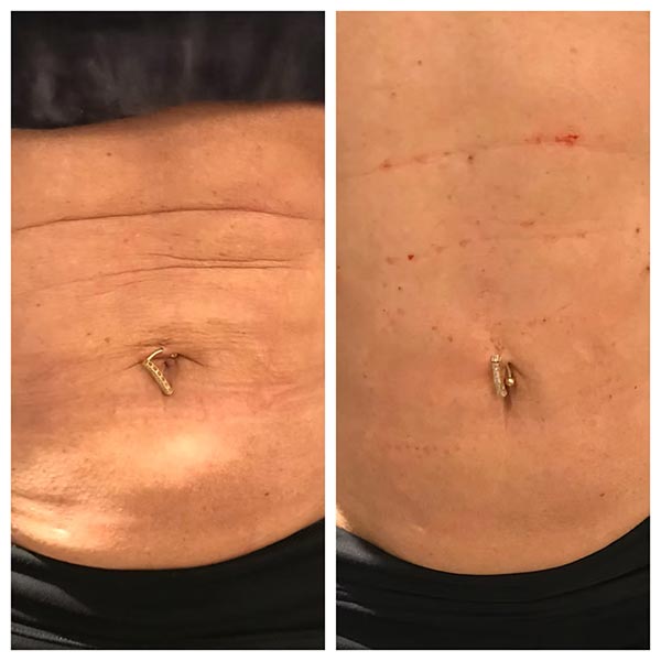 Other Treatments - Before and After Treatment at Kureshi Med Spa and Weight Loss in McKinney, TX Other Treatments - Before and After Treatment at Kureshi Med Spa and Weight Loss in McKinney, TX